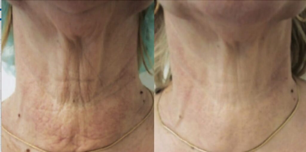 Skinbooster behandling