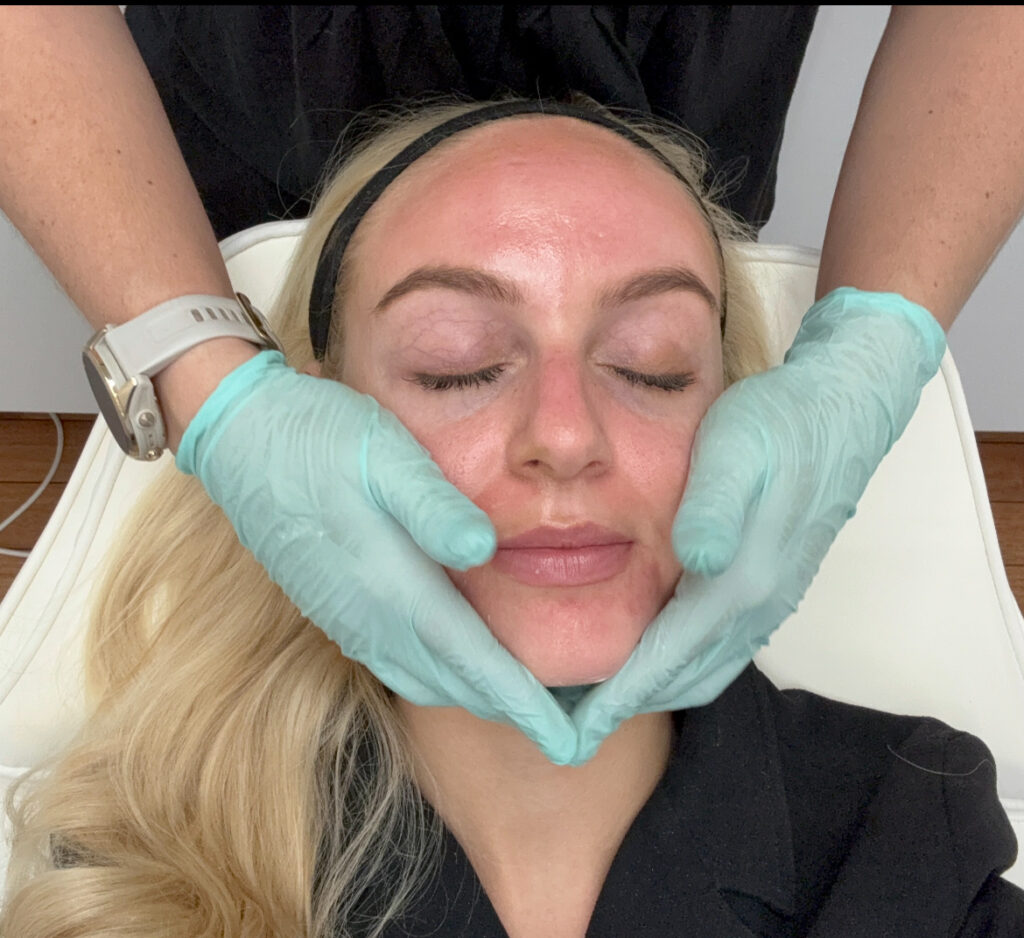 Microneedling behandling