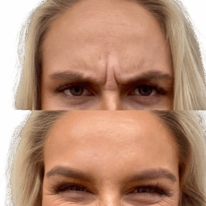 Botox bekymringsrynke