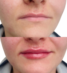 Filler behandling i læber