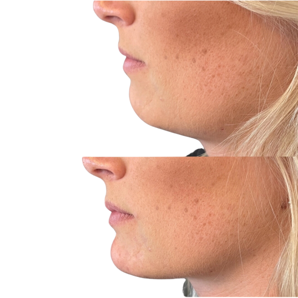 Filler i hage og kæbe