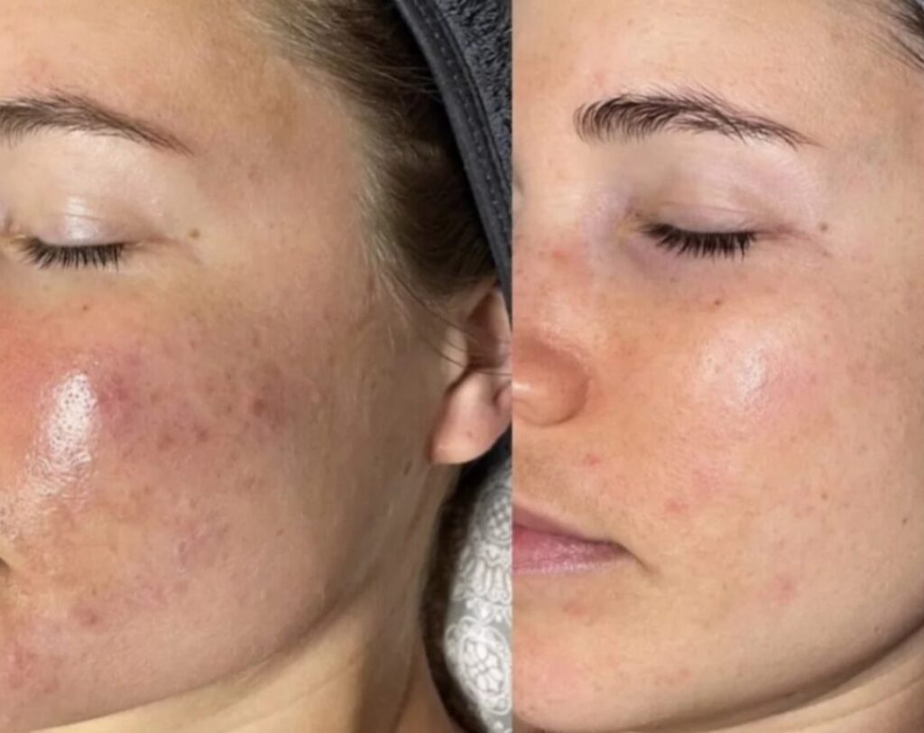 Microneedling i Aarhus