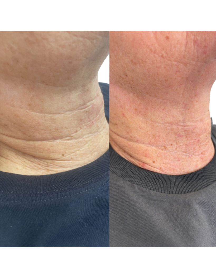 Skinbooster behandling