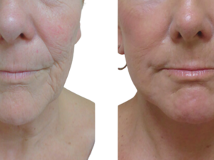 CO2 Laser under ansigt