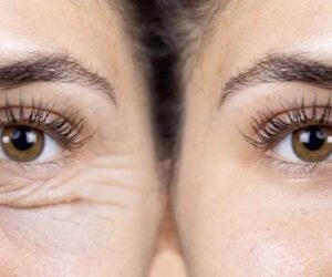 Co2 laser øjne aarhus